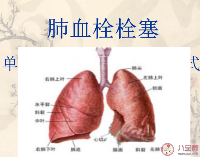 阳性一个月后肺栓塞风险增加33倍是真的吗 肺栓塞是什么疾病