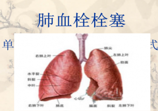 阳性一个月后肺栓塞风险增加33倍是真的吗 肺栓塞是什么疾病