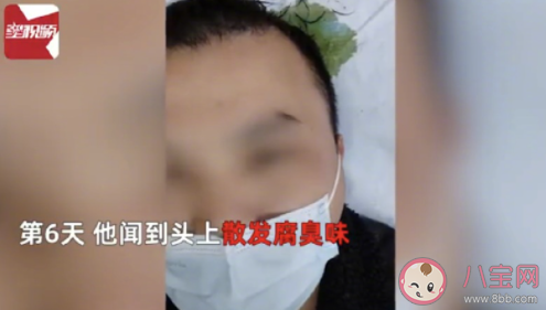 男子打球6天后头皮里发现2颗牙是怎么回事 牙齿被撞掉了该怎么办