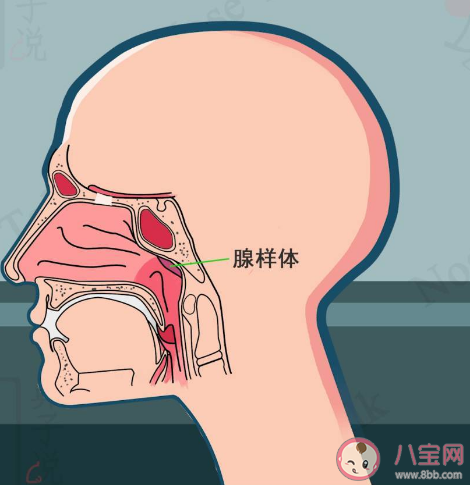 为什么腺样体肥大孩子越来越多 引起孩子腺样体肥大的原因有哪些