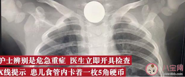 2岁娃咳嗽50天查出硬币卡喉是怎么回事 孩子不小心被异物卡住如何应对 2岁娃咳嗽50天查出硬币卡喉是怎么回事 孩子不小心被异物卡住如何应对