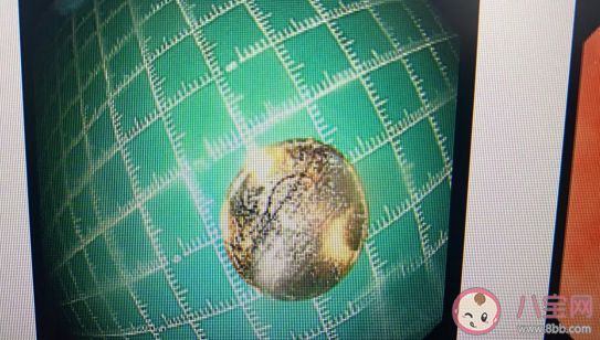 2岁娃咳嗽50天查出硬币卡喉是怎么回事 孩子不小心被异物卡住如何应对 2岁娃咳嗽50天查出硬币卡喉是怎么回事 孩子不小心被异物卡住如何应对