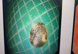 2岁娃咳嗽50天查出硬币卡喉是怎么回事 孩子不小心被异物卡住如何应对