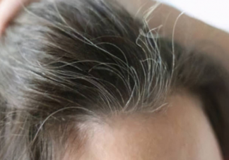 7类人容易提前长白发 如何控制白发增多