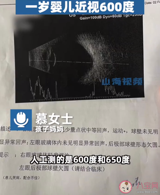 父母高度近视1岁婴儿近视600度是遗传吗 近视会不会影响下一代