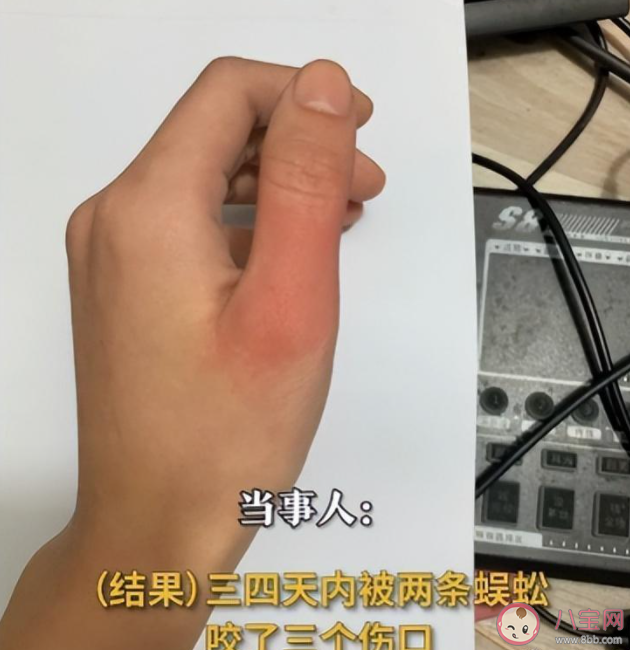 女子睡觉时被10厘米蜈蚣咬太阳穴是怎么回事 被蜈蚣咬了会怎么样