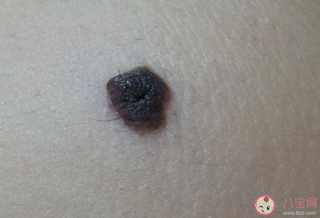 什么样的痣会癌变 哪些部位的痣要多加注意