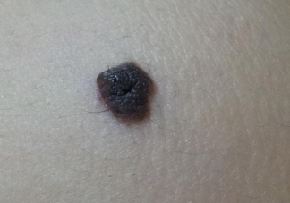 什么样的痣会癌变 哪些部位的痣要多加注意