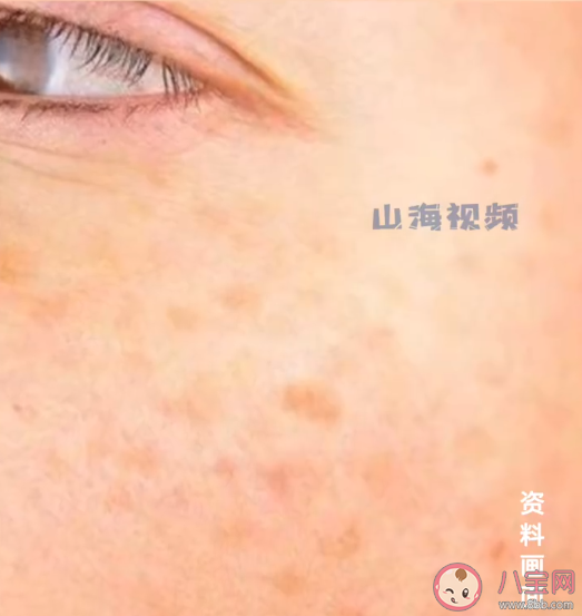 25岁女生长期熬夜长出老年斑 年轻人为什么会长老年斑