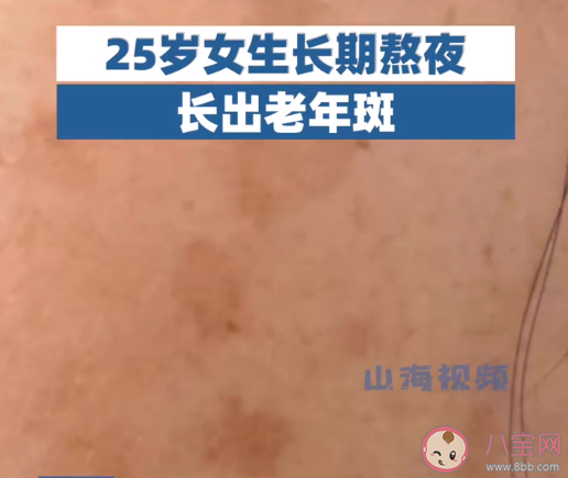 25岁女生长期熬夜长出老年斑 年轻人为什么会长老年斑