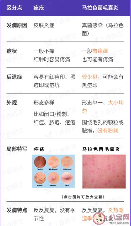 为什么背后的痘痘去不掉 背上长痘痘怎么办