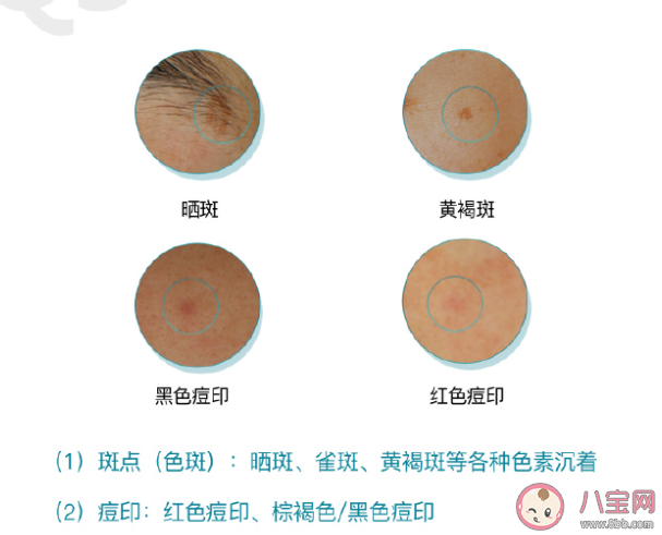 斑点痘印成因到底是什么 如何科学淡斑淡痘印