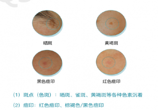 斑点痘印成因到底是什么 如何科学淡斑淡痘印