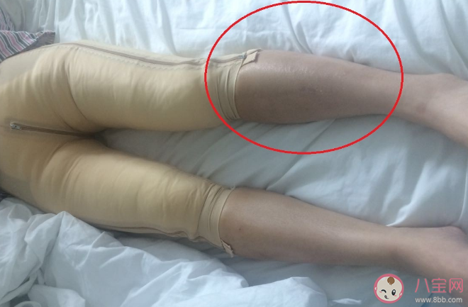 吸脂手术适用什么人适合减肥吗 吸脂手术的原则