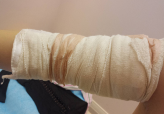 吸脂手术适用什么人适合减肥吗 吸脂手术的原则