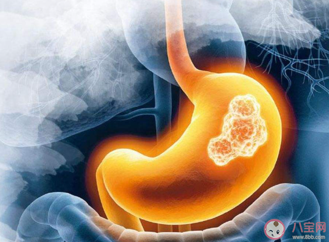 年纪轻轻就得胃癌多因6个不良习惯 怎样保护我们的胃