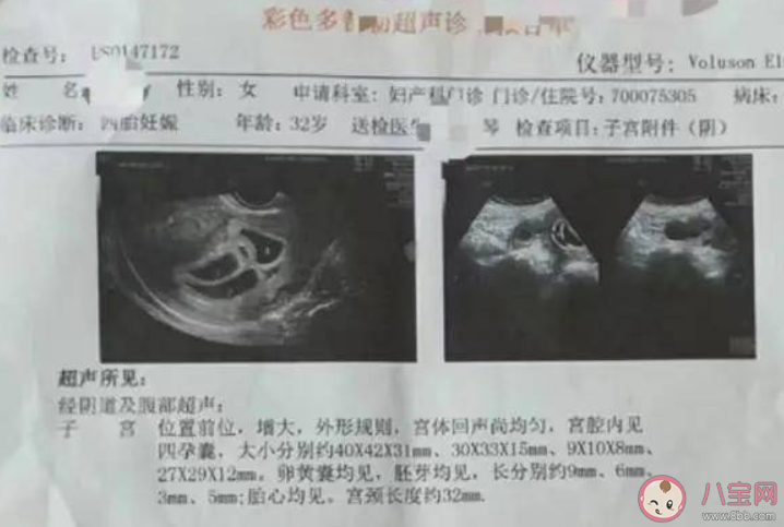 四胞胎宝妈产后9个月再怀四胞胎 多胞胎是如何怀上的