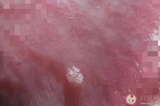 男童喉咙长菜花样肿块确诊感染HPV 感染了HPV就是性生活混乱吗