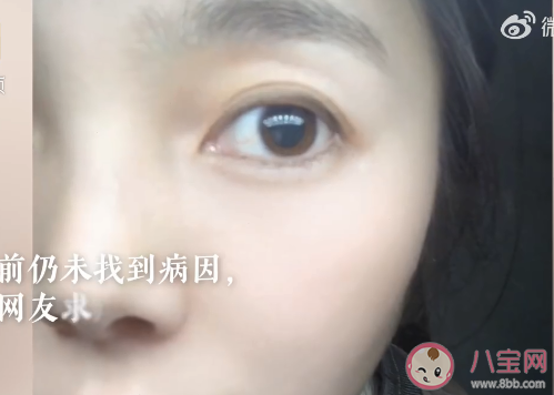 女子左眼瞳孔变大2倍找不到病因 瞳孔变大了会怎样