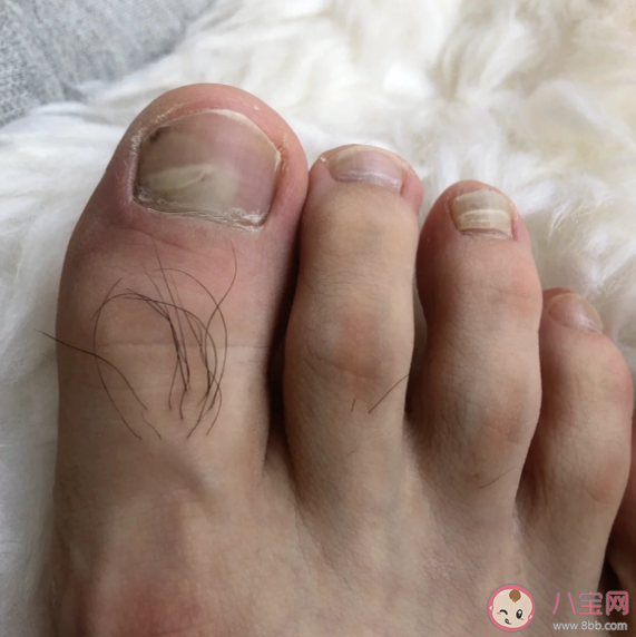 踢到脚趾为什么这么疼 踢到脚趾很疼怎么办