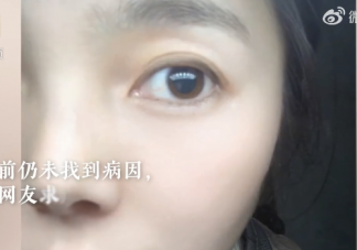 女子左眼瞳孔变大2倍找不到病因 瞳孔变大了会怎样