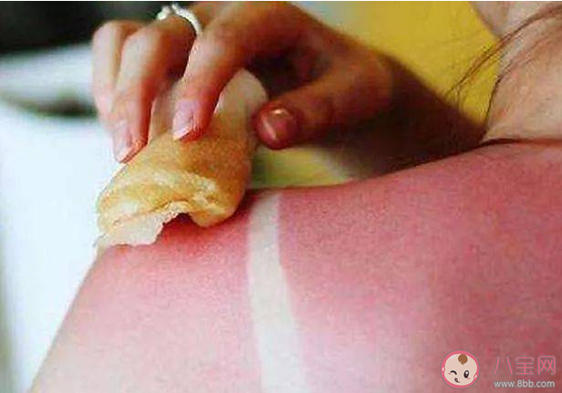 女子云南穿破洞裤7小时腿被晒伤 被晒伤了该怎么处理