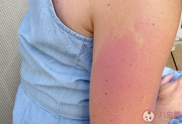 女子云南穿破洞裤7小时腿被晒伤 被晒伤了该怎么处理
