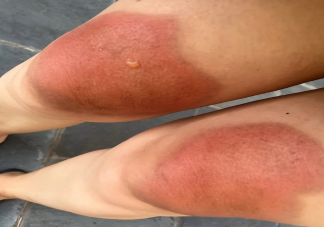 女子云南穿破洞裤7小时腿被晒伤 被晒伤了该怎么处理