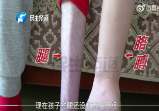 25岁女孩体重只有60多斤正常吗 太瘦了有什么危害