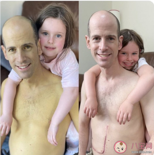 肝脏移植前后肤色对比 为什么肝脏好坏会显在皮肤上