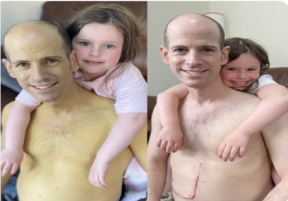 肝脏移植前后肤色对比 为什么肝脏好坏会显在皮肤上