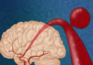 女子工作中发生争吵气炸脑血管是怎么回事 生气会让血管爆炸吗