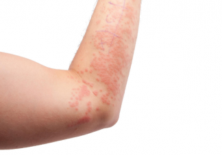 不小心拍打隐翅虫后如何处理 发现隐翅虫怎么办