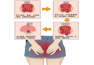 无痛无痒就没有痔疮吗 痔疮能自愈吗