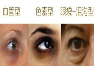 多睡觉能让黑眼圈消失吗 黑眼圈可以通过涂抹眼霜改善吗