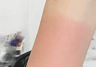 晒后黄金修复时期是什么时候 皮肤晒伤后应该如何急救