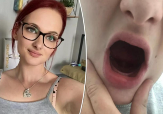 26岁女子生完孩子牙齿掉光是怎么回事 孕吐会导致掉牙吗