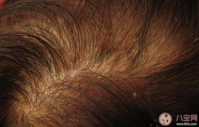 头皮上长痂能不能抠 脂溢性皮炎可以根治吗