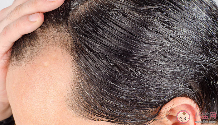 头皮上长痂能不能抠 脂溢性皮炎可以根治吗