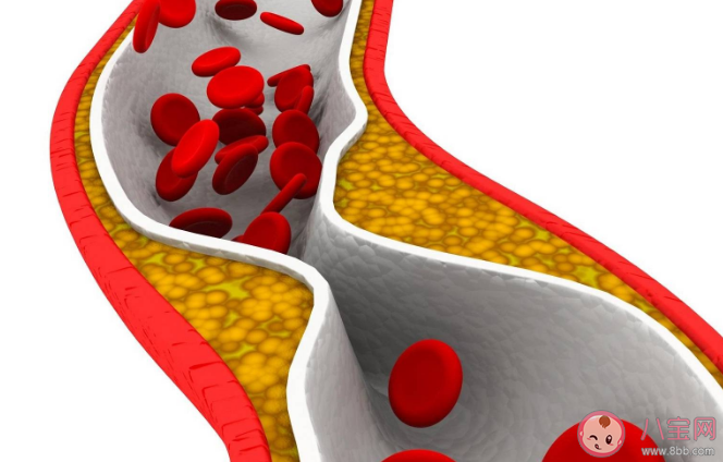 6种食物易导致动脉粥样斑块 动脉粥样硬化形成主要经过哪几步