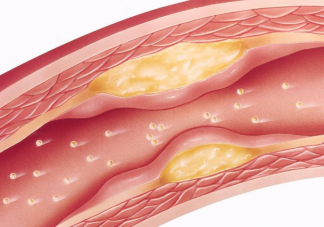 6种食物易导致动脉粥样斑块 动脉粥样硬化形成主要经过哪几步