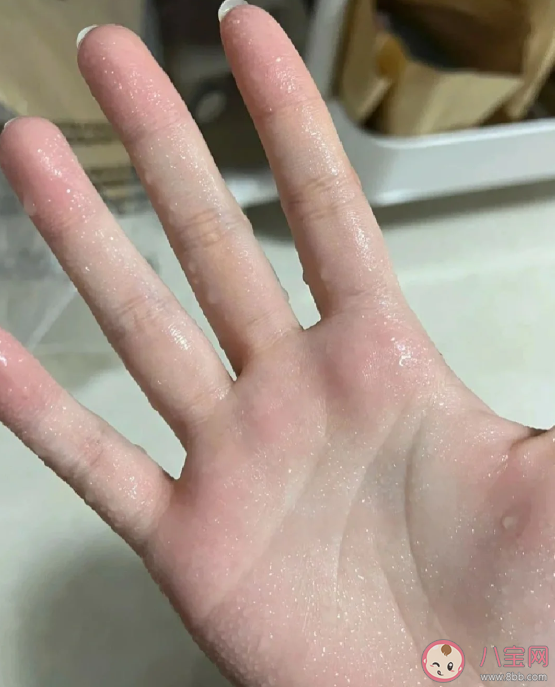 手汗症为什么要去胸外科治疗 手汗症需要手术治疗吗