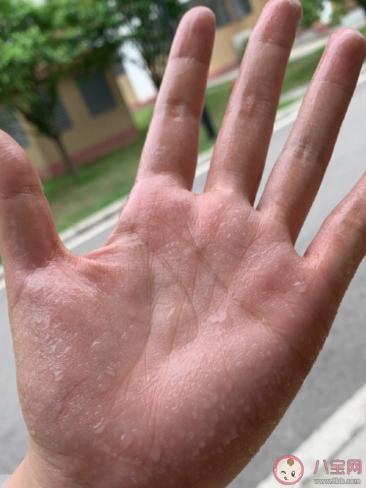 手汗症为什么要去胸外科治疗 手汗症需要手术治疗吗