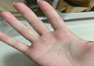 手汗症为什么要去胸外科治疗 手汗症需要手术治疗吗