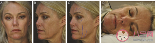 睡觉总是侧卧的人更易长皱纹 皱纹是怎么长出来的
