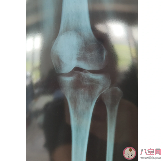 骨头为什么会长刺 远离骨刺要注意什么