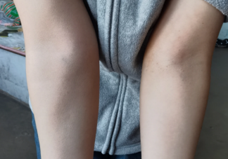 骨头为什么会长刺 远离骨刺要注意什么