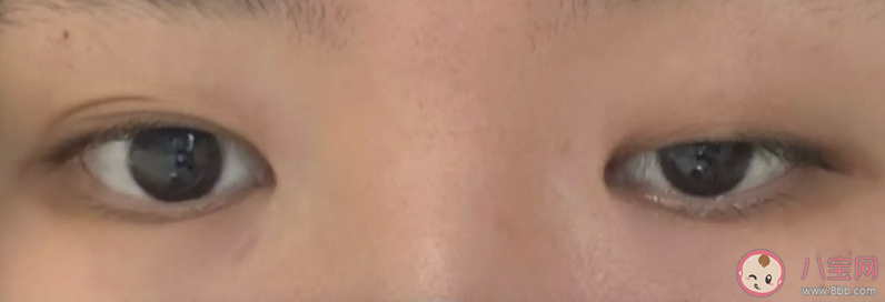 上睑下垂能自愈吗 上睑下垂有哪些治疗方法