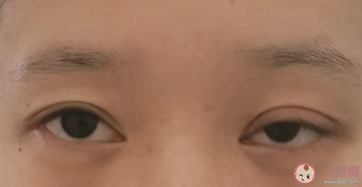 上睑下垂能自愈吗 上睑下垂有哪些治疗方法