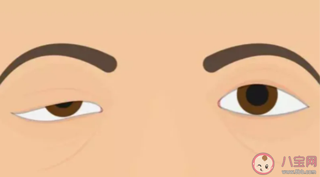 上睑下垂能自愈吗 上睑下垂有哪些治疗方法